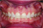 (2.) Pretreatment retracted view demonstrating worn anterior teeth and a reduced vertical dimension.