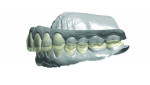 (7.) Frontal and left-side views, respectively, of the initial digital design of the minimal preparation occlusal veneers for the posterior teeth, full-coverage crown restorations for the maxillary anterior teeth, and labial veneers for the mandibular anterior sites. Note how the occlusal veneers on the posterior teeth are designed to reestablish the patient’s occlusal
vertical dimension.