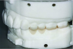 (9.) Left-side and occlusal views of the 3D printed posterior occlusal veneers on the model. Note that there are several areas where the material thickness is extremely thin (eg, the occlusalpalatal aspects of teeth Nos. 2 and 15).