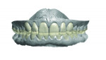 (6.) Frontal and left-side views, respectively, of the initial digital design of the minimal preparation occlusal veneers for the posterior teeth, full-coverage crown restorations for the maxillary anterior teeth, and labial veneers for the mandibular anterior sites. Note how the occlusal veneers on the posterior teeth are designed to reestablish the patient’s occlusal
vertical dimension.