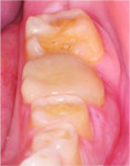 (5.) Close-up view of a full coverage crown on tooth No. 19 that was placed previously by a different practitioner. Note the lack of anatomy and diminished crown height that is often required when restoring individual teeth in the presence of generalized wear.