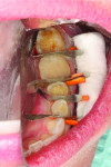 (11.) Occlusal view of the mandibular left posterior sextant prepared for additive occlusal veneer bonding. Note the preexisting ceramic crown on tooth No. 19 to which a 3D printed occlusal veneer will bond without necessitating preexisting crown removal.