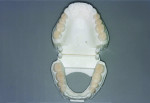 (10.)  Left-side and occlusal views of the 3D printed posterior occlusal veneers on the model. Note that there are several areas where the material thickness is extremely thin (eg, the occlusalpalatal aspects of teeth Nos. 2 and 15).