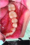 (12.) Occlusal view of the mandibular left posterior sextant after bonding of the 3D printed occlusal veneers and initial resin cement removal.