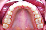 (17.) Posttreatment maxillary occlusal view.