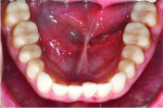 (18.) Posttreatment mandibular occlusal view.