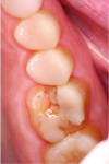 (20.) One-year postoperative occlusal view of the 3D printed occlusal veneer on tooth No. 14 demonstrating fracture.