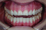 (2.) Pretreatment retracted photograph with teeth apart.