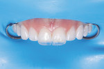 (10.) The initial lingual shelf layers were placed on both teeth simultaneously using the chosen achromatic enamel shade of composite.