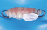 (11.) Tooth No. 8 would be restored first, so PTFE tape was placed on tooth No. 9 to prevent resin from bonding to it.