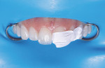 (12.) The initial dentin shade layer of composite was placed, extending the resin over the fracture line and bevel.