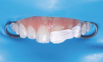 (13.) White tints were placed to mimic the characterizations present in the natural dentition prior to applying the final layer of
achromatic enamel shade composite.