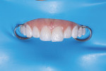 (14.) After the same composite layering protocol was followed for tooth No. 9, both restorations
were ready for shaping, finishing, and polishing.