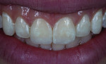 (17.) Two-week postoperative smile photograph.