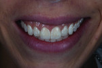 (18.) Two-week postoperative smile photograph close-up view. Note how the final layer of achromatic enamel caused the restorations to appear lower in value and display a clear delineation between the composite and the natural tooth structure.