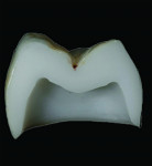 (1.) Early versions of 3Y zirconia demonstrating poor esthetics, improved esthetics achieved through pre-sinter infiltration, and improved esthetics achieved through microlayering, respectively.