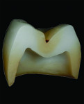 (2.) Early versions of 3Y zirconia demonstrating poor esthetics, improved esthetics achieved through pre-sinter infiltration, and improved esthetics achieved through microlayering, respectively.