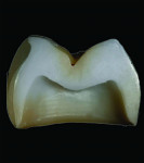 (3.) Early versions of 3Y zirconia demonstrating poor esthetics, improved esthetics achieved through pre-sinter infiltration, and improved esthetics achieved through microlayering, respectively.