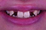 (4.) Pretreatment smile photograph of a patient missing teeth Nos. 7 and 10.