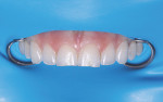 (4.) A split dam isolation technique was used with a heavy gauge rubber dam and bite registration material to block the palate.