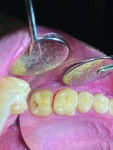 (1.) Pre-restoration occlusal view of teeth Nos. 14 and 15 prepared for an occlusal and mesio-occlusal restoration, respectively.