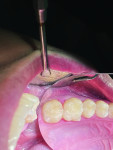 (2.) Posttreatment occlusal view of of teeth Nos. 14 and 15 following restoration with Beautifil Flow Plus X.