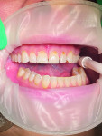 (3.) Pretreatment retracted view of
cervical lesions on teeth Nos. 5 through 12.