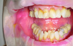 (5.) Pretreatment view of maxillary cervical lesions with gingival defects on teeth Nos. 6, 7, 8, 9, and 11.