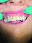 (6.) Posttreatment view of teeth Nos. 6, 7, 8, 9, and 11 following restoration with Beautifil II and Beautifil II Gingiva.