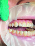 (1.) Preoperative retracted right lateral, frontal, and left lateral photographs, respectively. The dark brown areas indicate where the decay process has begun within the preexisting abfraction/wear lesions.