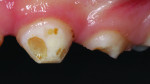 (1.) Pretreatment close-up view of buccal caries on primary tooth H.