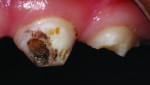 (3.) Immediate posttreatment view of the staining following SDF application.