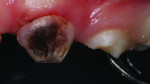 (4.) View of the staining, which had become darker, at the restorative appointment.