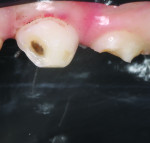 (5.) View of the completed preparation. Note the dark stain that remained at its center, illustrating that the deepest part of the lesion had been treated with SDF.