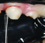 (9.) A single-shade, flowable bulk-fill composite was placed to complete the restoration, which was then shaped and contoured to match the natural anatomy of tooth H and light cured.