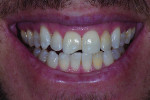 (1.) Pretreatment smile, retracted, and retracted with teeth apart photographs. Note the incisal Class IV chips on teeth Nos. 8 and 25 and how tooth No. 7 is not symmetrical when compared with teeth Nos. 8 and 10.