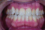 (2.) Pretreatment smile, retracted, and retracted with teeth apart photographs. Note the incisal Class IV chips on teeth Nos. 8 and 25 and how tooth No. 7 is not symmetrical when compared with teeth Nos. 8 and 10.