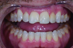 (3.) Pretreatment smile, retracted, and retracted with teeth apart photographs. Note the incisal Class IV chips on teeth Nos. 8 and 25 and how tooth No. 7 is not symmetrical when compared with teeth Nos. 8 and 10.