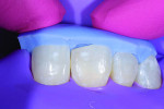 (4.) After a rubber dam was placed to isolate the teeth, the fit of the lingual putty matrix for teeth Nos. 7 and 8 was confirmed.