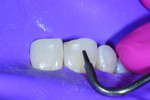 (5.) Tooth No. 8 was beveled and then air abraded.