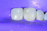 (7.) A bonding agent was placed on tooth No. 8 and light cured, and then composite was placed into the lingual putty matrix and used to create a lingual shelf.