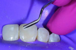 (10.) A composite instrument was used to complete the contouring, and then teeth Nos. 7 and 25 were treated using a similar protocol.