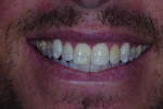 (11.) Posttreatment smile, retracted, and retracted with teeth apart photographs showing the final results after polishing.