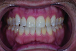 (12.) Posttreatment smile, retracted, and retracted with teeth apart photographs showing the final results after polishing.