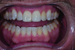 (13.) Posttreatment smile, retracted, and retracted with teeth apart photographs showing the final results after polishing.