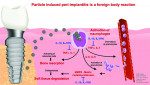 (1.) Peri-implantitis can follow a foreign body type reaction that triggers the host’s immune response and results in soft-tissue degradation and bone loss around an implant.