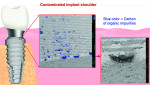 (2.) Contaminants at the implant’s shoulder can lead to peri-implant disease either prior to initiation of the restorative phase or long term.