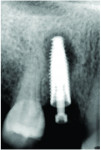 (12.) Periapical radiolucency developing on a non-loaded implant that was recently placed in a healed site, which could be related to the presence of contaminants on the implant at placement.