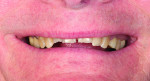 Fig. 2: Pretreatment smile photograph displaying broken-down dentition and reduced vertical dimension.