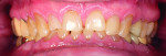 Fig. 3: Pretreatment retracted smile photograph showing occlusion and reduced vertical dimension.